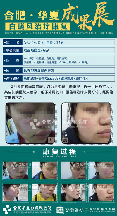 白癜风治疗要花多少钱?